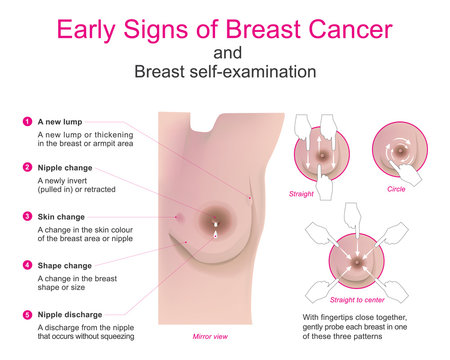 Early signs of breast cancer and breast self-examination. Vector chart.