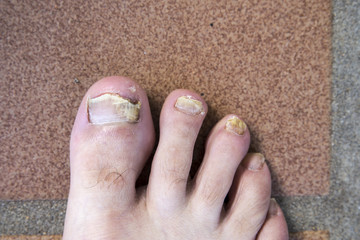onychomycosis with fungal nail infection two feet