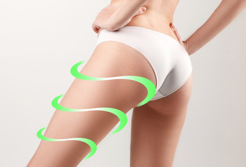 Marks on the women's buttocks, waist and legs before plastic surgery.