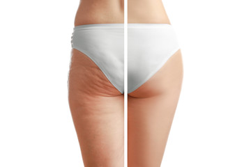 Young woman body before and after anti cellulite treatment on white background - obrazy, fototapety, plakaty