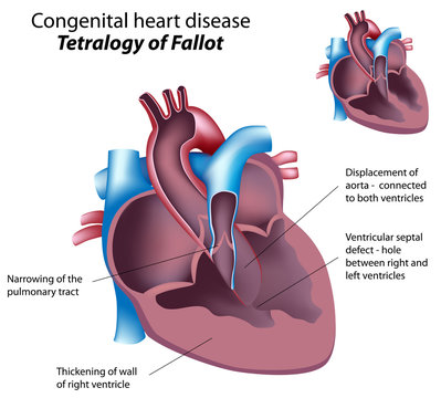 Congenital heart disease: Tetralogy of Fallot