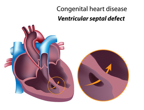 Congenital heart disease: ventricular septal defect