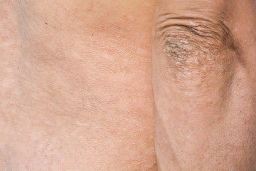 Fototapeta premium Psoriasis on the skin