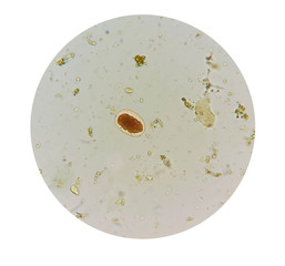 Stool parasites examination test for parasites or eggs in human stool sample with iodine stained under microscope. The parasites are associated with intestinal infections.