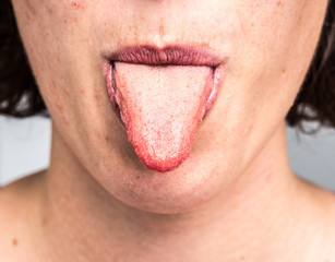 Tongue of woman with candidiasis