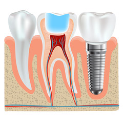 Dental implant and real tooth anatomy closeup
