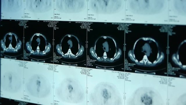 doctor study human orage & bone pet-ct scan,X-ray,Cancer metastasis.