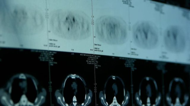 human subclavian pet-ct scan,lymph nodes X-ray,Cancer metastasis.	