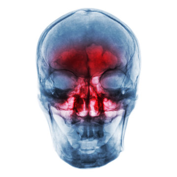 Sinusitis . Film x-ray of human skull with inflamed at sinus