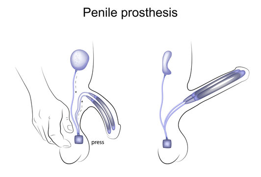 Penile Prosthesis. Urology