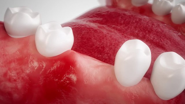 Dental implant - High end animation
In this animation film, you will see all the steps for using a dental implant. Use this film for your practice to inform the patient about all the steps.
