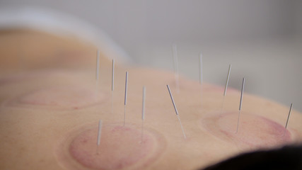Needles in the back of a woman on acupuncture