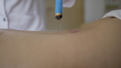 Doctor warms her back with an aromatic cigar - close up. Tibetan Medicine