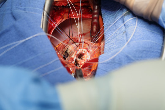 Process of open heart surgery