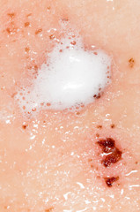 Fototapeta premium Wound on human skin in hydrogen peroxide
