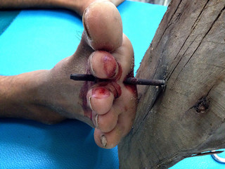 Penetrating wound injury by nail.