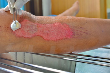 Dressing laceration wound after motorcycle was accident.