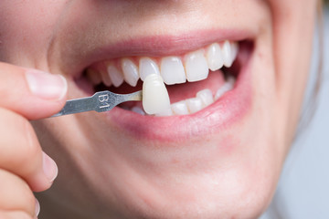 Farbabgleich mit Farbmuster an den Z&auml;hnen