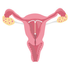 Intrauterine device IUD in uterus. Female contraception. Scheme of female organs, reproductive system, uterus in a section, medicine. Vector illustration AI10