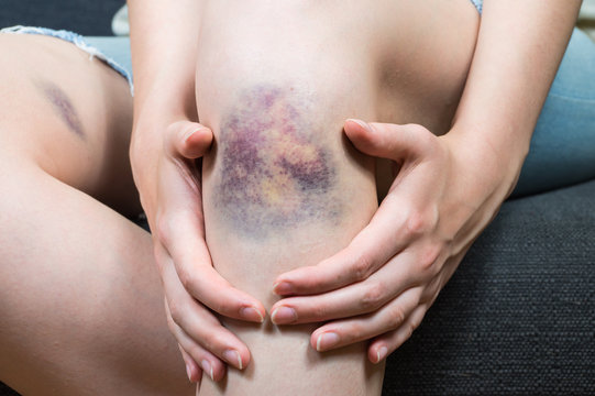 Bruise injury on young woman knee. Close up image of female person sitting on sofa and holding in hands wounded leg with hematoma