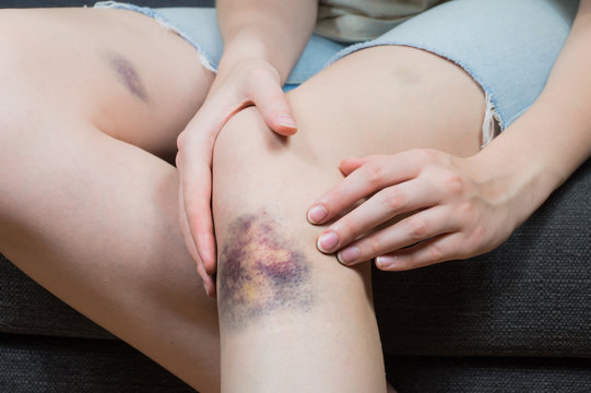 Checking bruise injury on young woman knee. Close up image of female person sitting on sofa and examining wounded leg with hematoma