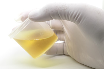 Healthcare And Medicine. Medical urine test, close-up,Urine sample.