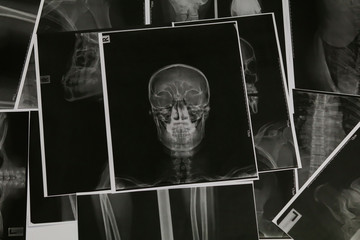 Skull x-ray image.