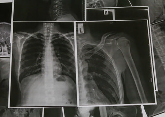 X-Ray Image of Human Chest for a medical diagnosis.Chest and lungs Xray photo