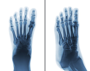 Film x-ray both normal human foots .