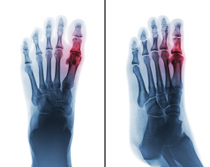 Gouty arthritis . film x-ray of human foot and arthritis at first metatarsophalangeal Joint .