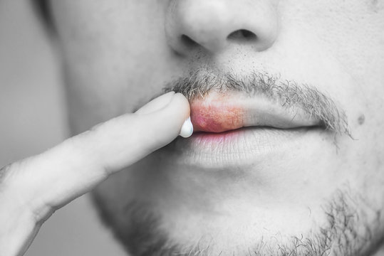 Herpes On Lips Of The Young Man. Man Smears Herpes With Herpes Cream