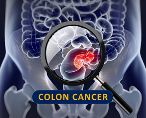Colon or Colorectal cancer,medical anatomical illustration.3d illustration