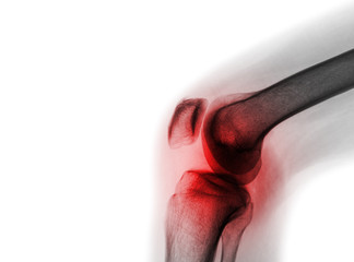 Film x-ray knee joint with arthritis ( Gout , Rheumatoid arthritis , Septic arthritis ,...
