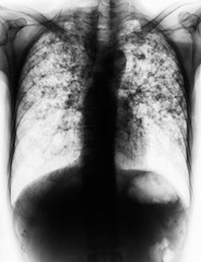 Pulmonary Tuberculosis .