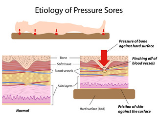 Etiology of pressure sores - obrazy, fototapety, plakaty