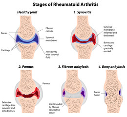 Stages of rheumatoid arthritis - obrazy, fototapety, plakaty