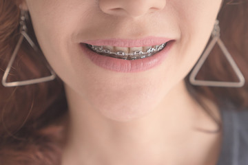 Close up of smile girl with metal braces.
