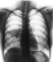 Pneumonia ( film chest x-ray show alveolar infiltrate at right middle lung )