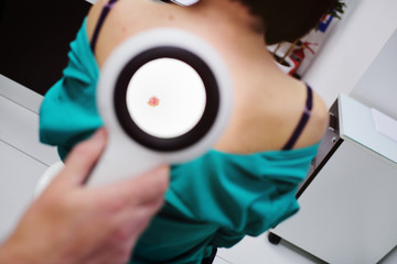 The dermatologist examines the patient's moles with the help of a special electoral magnifying glass. Prevention of melanoma. - obrazy, fototapety, plakaty