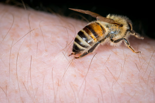 Biene Honigbiene (Apis mellifera) sticht in die Haut des Menschen