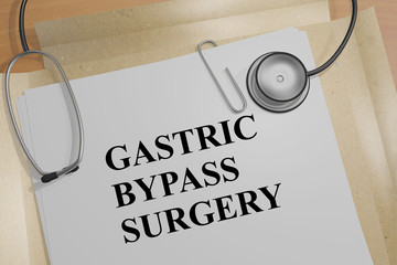 Gastric Bypass Surgery - medical concept - obrazy, fototapety, plakaty