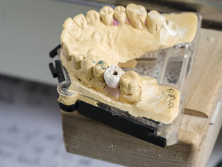 Closeup of dental technician applying ceramic to teeth, implant before putting into the furnace