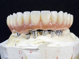 Monolithic zirconia restorations full arch implant supported with the ceramic load in vestibular, back background