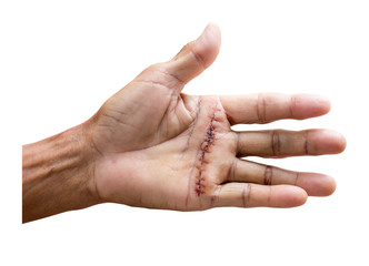 Results of hand surgery of accident isolated on white with clipping path, Pain of accident concept