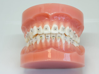 Artificial model of human jaw with wire colorful braces attached.