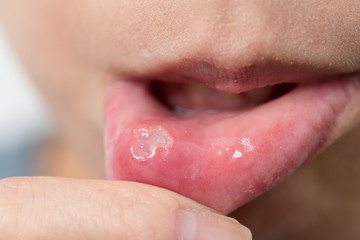 Woman suffer from aphtha