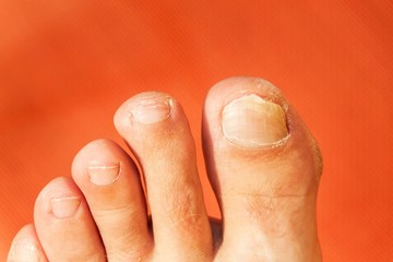 Flies on your fingers. Close up shot of a bad nail finger. Nail care on the foot - pedicure.