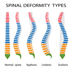 Spinal deformity types. - obrazy, fototapety, plakaty