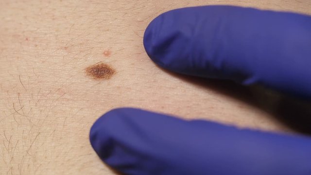 Doctor examines birthmark of patient