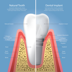 Human teeth and Dental implant Vector Illustration